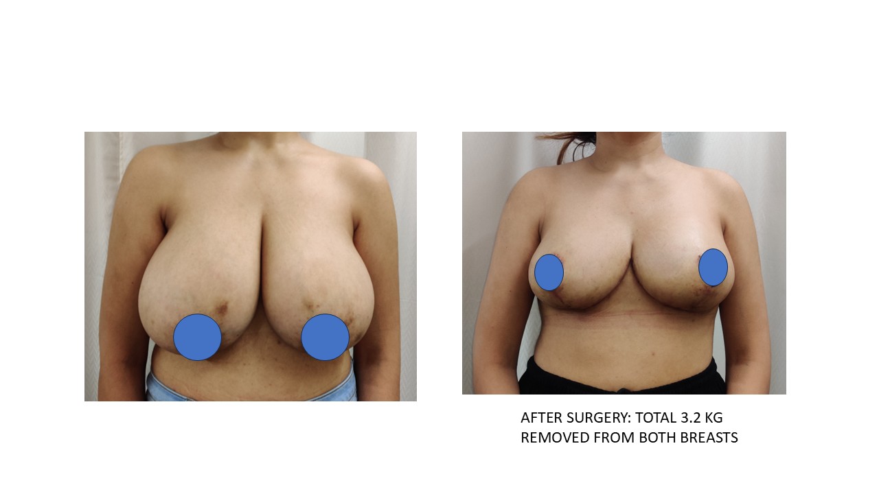 Breast Reconstruction Photo 3